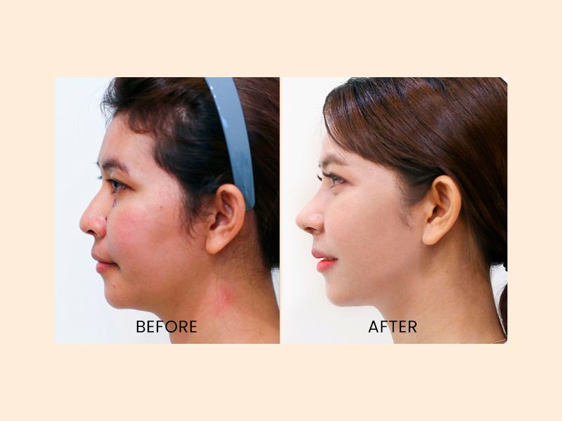 upturned nose caused by silicon implant - Revised rib carilage rhinoplasty  > Before & After Photo