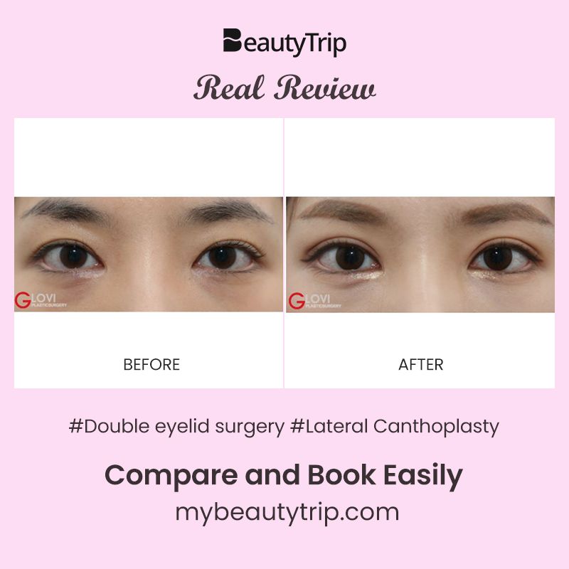 Double eyelid surgery best sale review